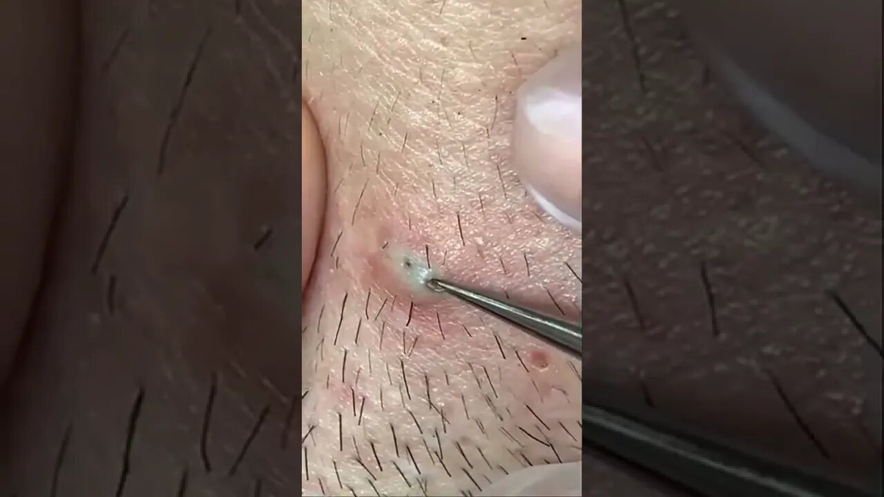 Blackheads Popping & Blackhead Removal Videos