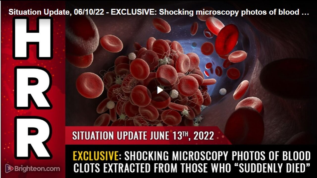 06-13-22 S.U. - Shocking Microscopy photos of Blood Clots Extracted From those Who Suddenly Died