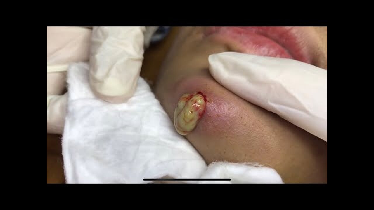 Very large Pimple Popper Cystic Acne Extraction