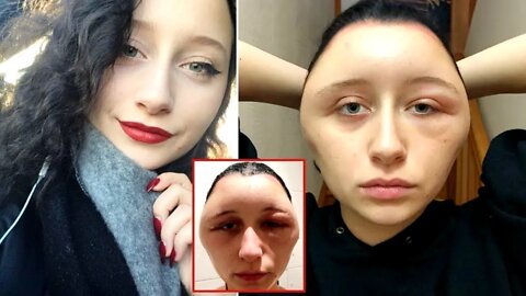 When Allergic Reactions Go Wrong