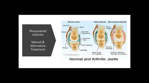 Rheumatoid arthritis - Natural & Alternative Treatment