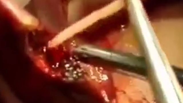 Doctor removes liver fluke from patients liver