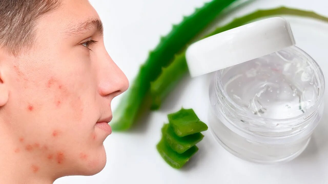 COMO FAZER SEU PRÓPRIO GEL SECATIVO PARA ACNE - FUNCIONA!