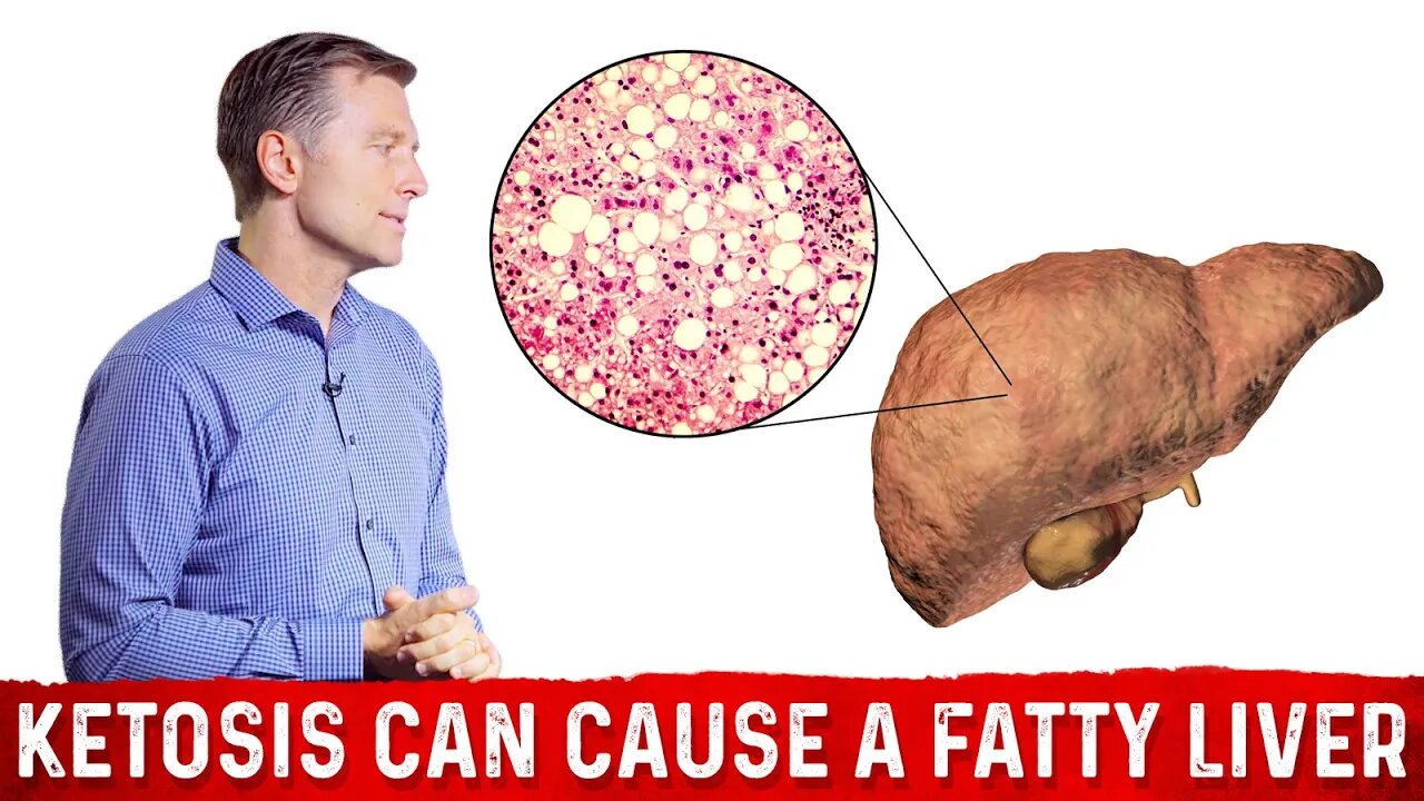 Can a Ketogenic Diet Cause Fatty Liver Disease? – Dr.Berg