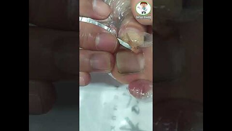 Best Video Removal Old Toenail & Big Ingrown DIY Designs Art 👣Toenail Roomb👣 #shorts 56