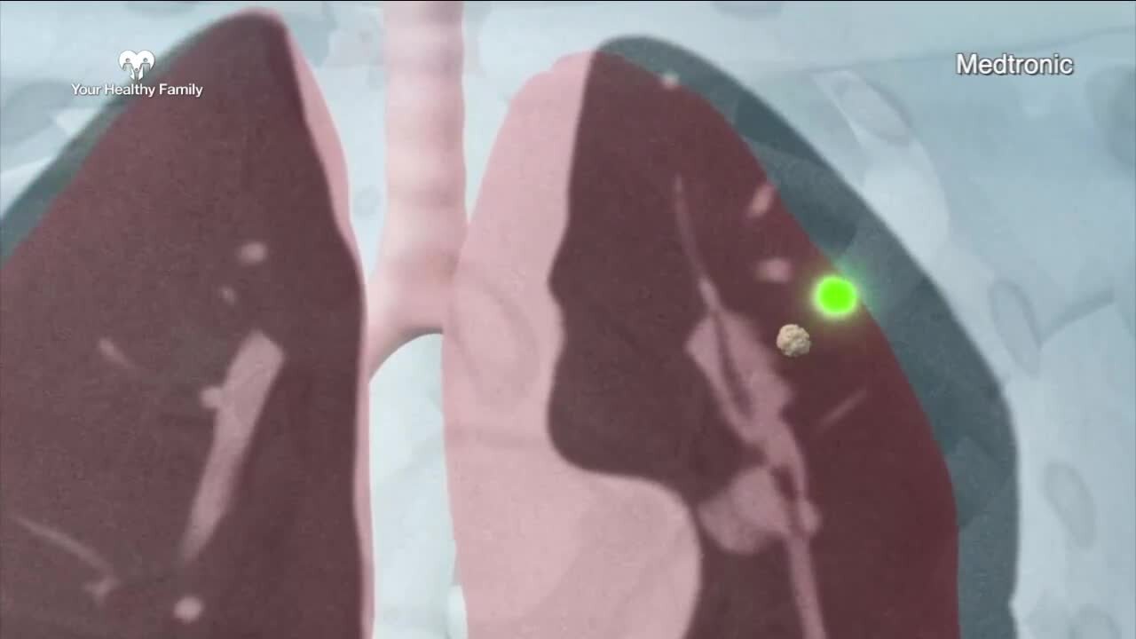 Your Healthy Family: Technology at NCH helps doctors diagnose and remove lung lesions