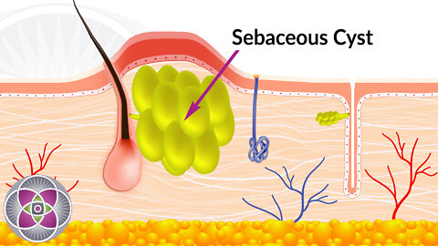 Acne & Acne Scarring : A Deep Dive Into the Cause & Treatment