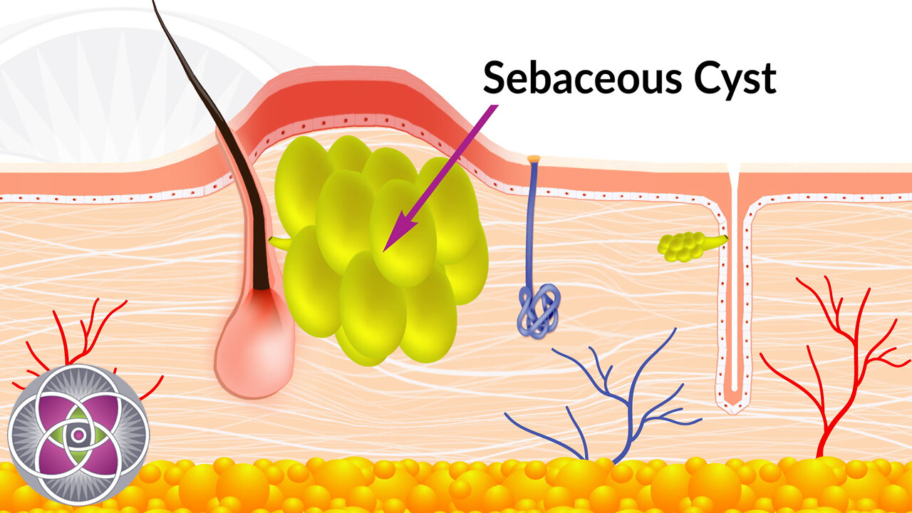 Acne & Acne Scarring : A Deep Dive Into the Cause & Treatment
