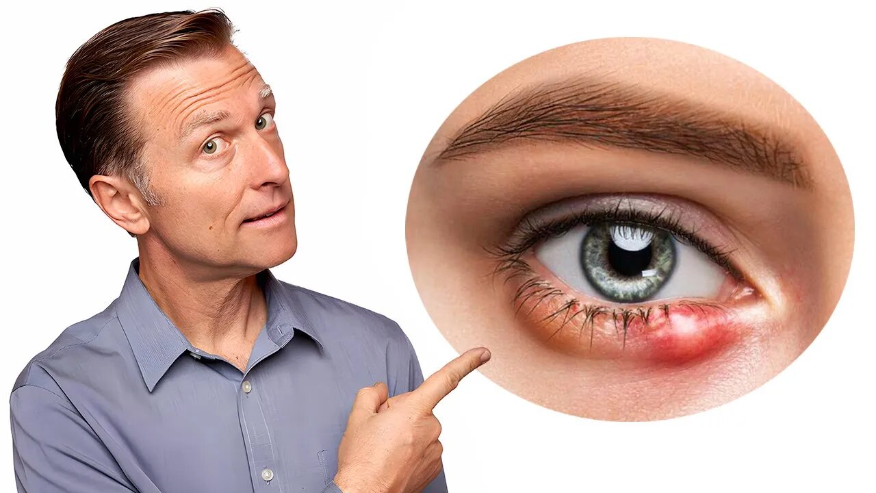 What Really Causes Styes and How to Get Rid of Them Fast