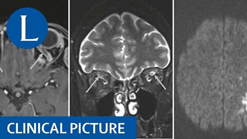 Clinical Picture | Neurological problems post vaccine against SARS-CoV-2 (Apr. 2021) | The Lancet