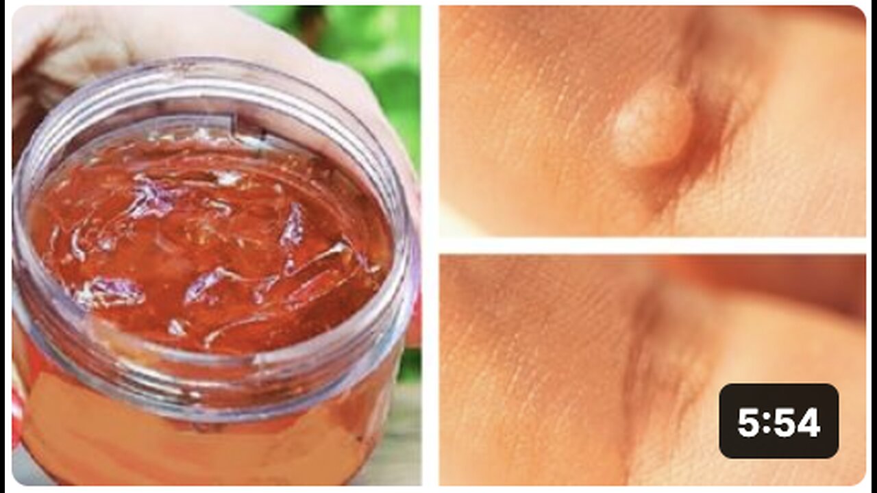 Rub This on Your Wart To Kill the Virus and Remove It Forever