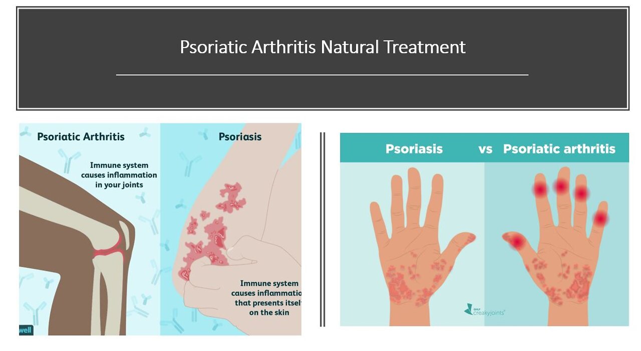 Psoriatic Arthritis Natural Treatment