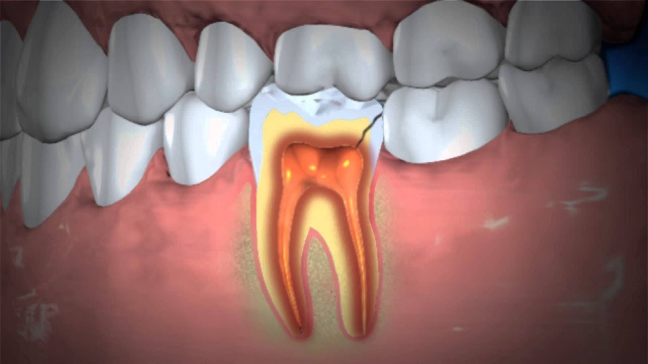 Natural cures: How to treat an abscessed tooth