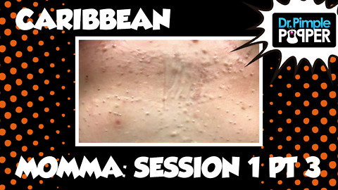 Caribbean Momma and her Steatocystomas: Session One, Part Three
