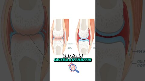 Rheumatoid Arthritis Symptoms [What is rheumatoid arthritis?]