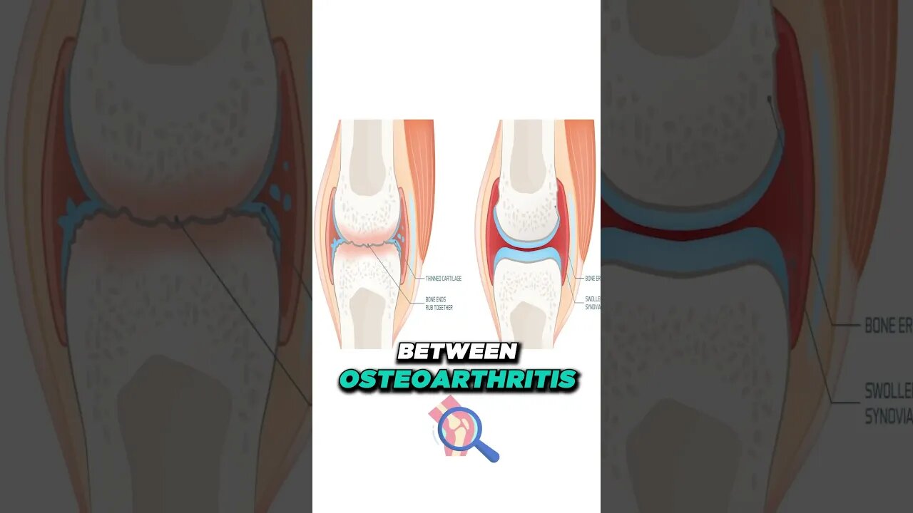 Rheumatoid Arthritis Symptoms [What is rheumatoid arthritis?]