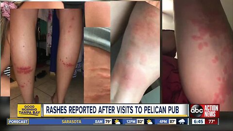 Complaint of rash break out at St. Pete bar prompts investigation