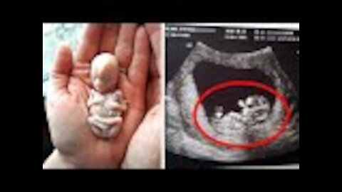 6 Weeks After This Mother Gave Birth, Doctors Found A Deadly Unborn Baby Growing Inside Her