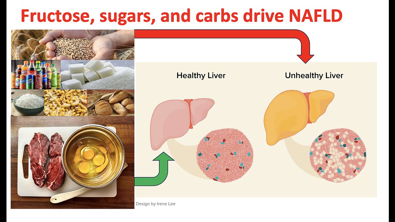 Fruit, honey, soda, and carbs drive liver disease