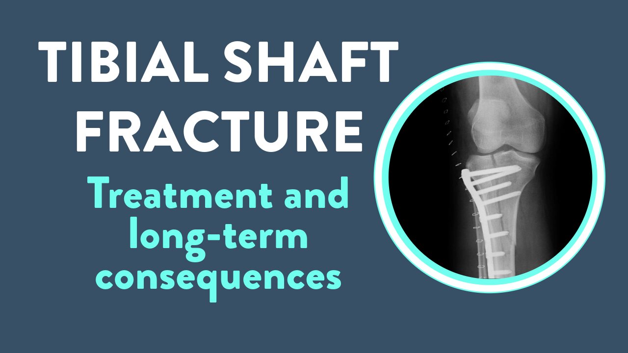 Tibial shaft fracture: Treatment and long-term consequences