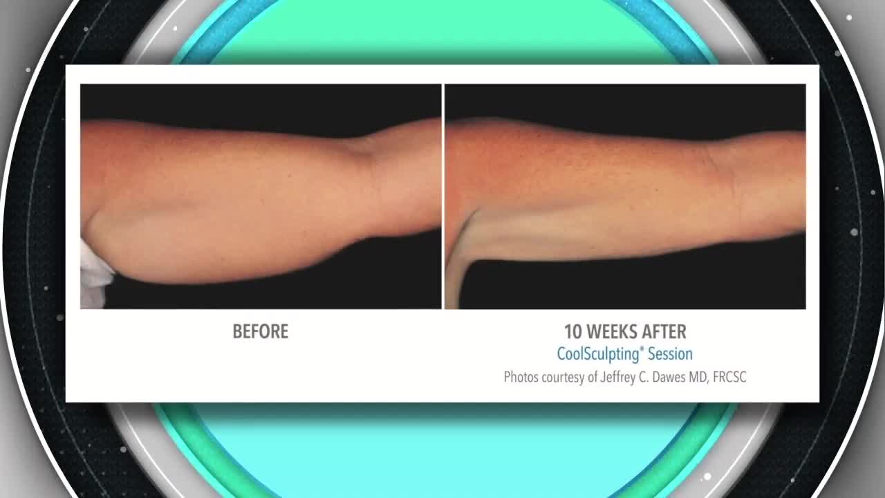 MD Body and Med Spa- Freeze Fat Denver