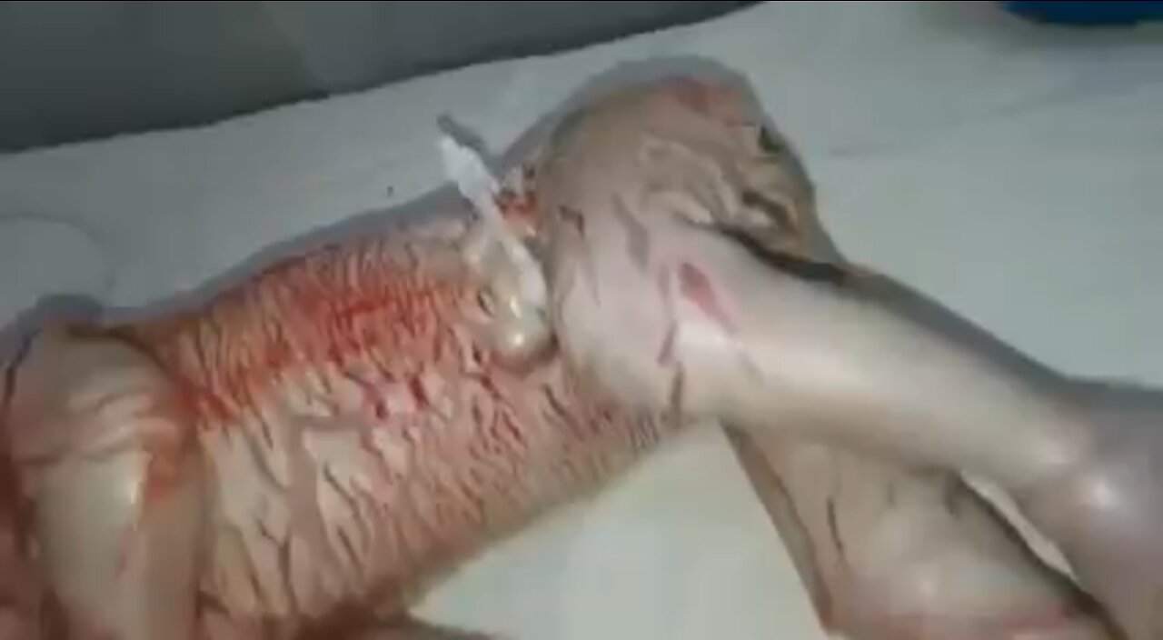 Graphic video!! The effect on the traces of 💉has been noticed