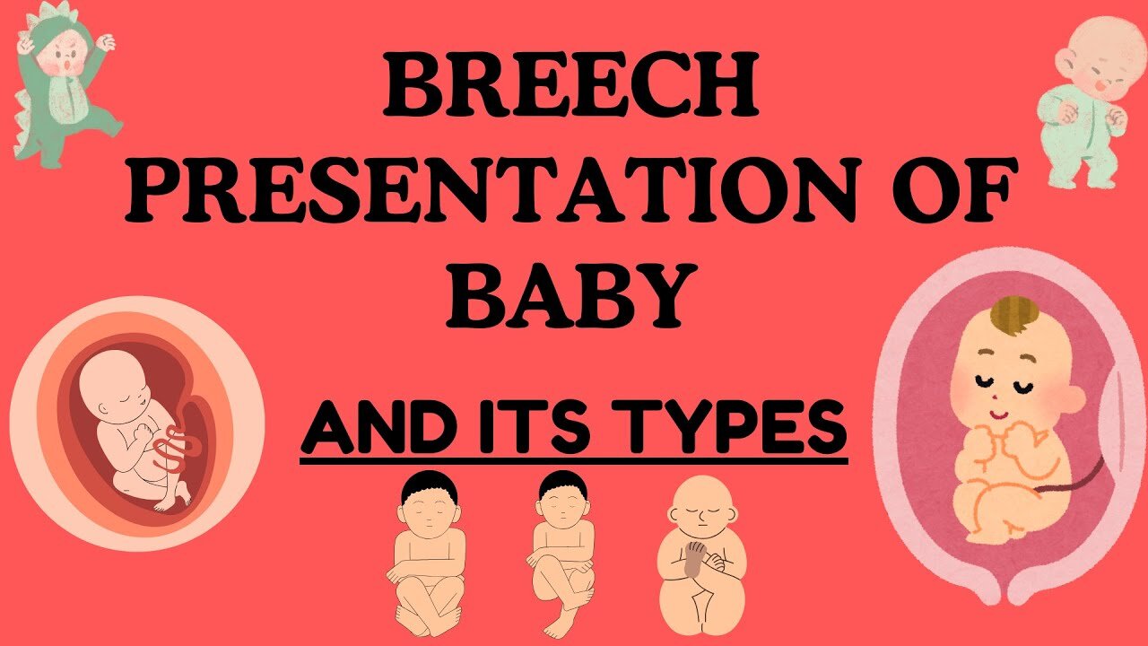 Breech Presentation of Baby: Understanding, Types, Risks, and Delivery Options| Novice Medic