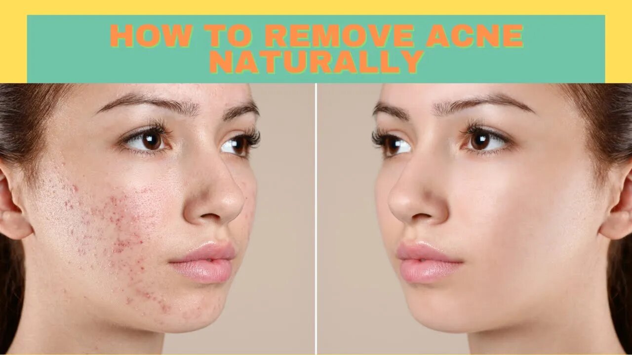 HOW TO REMOVE ACNE NATURALLY