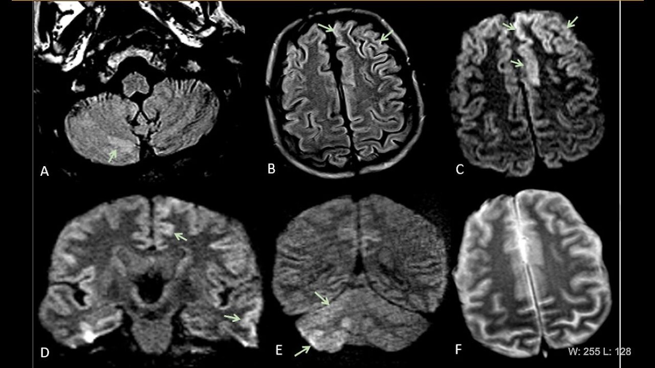 57% Of Spanish Covid Patients In Albacete Develop neurological disorders