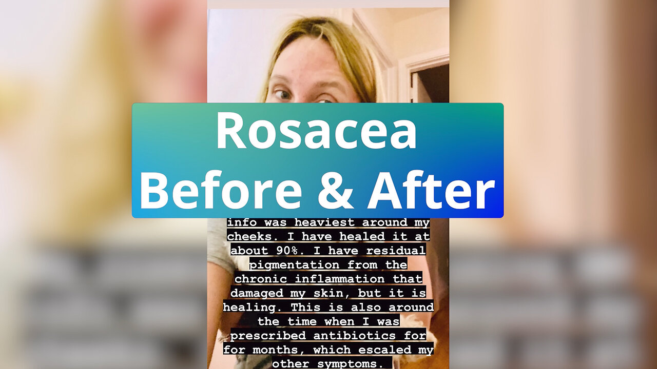 Rosacea Before & After - Repost from @heal_infertility