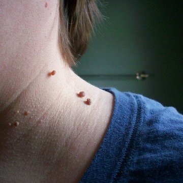 Skin Tags: What They Are and How to Get Rid of Them