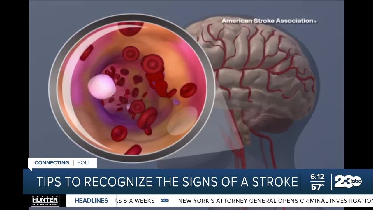 How to recognize the signs of a stroke