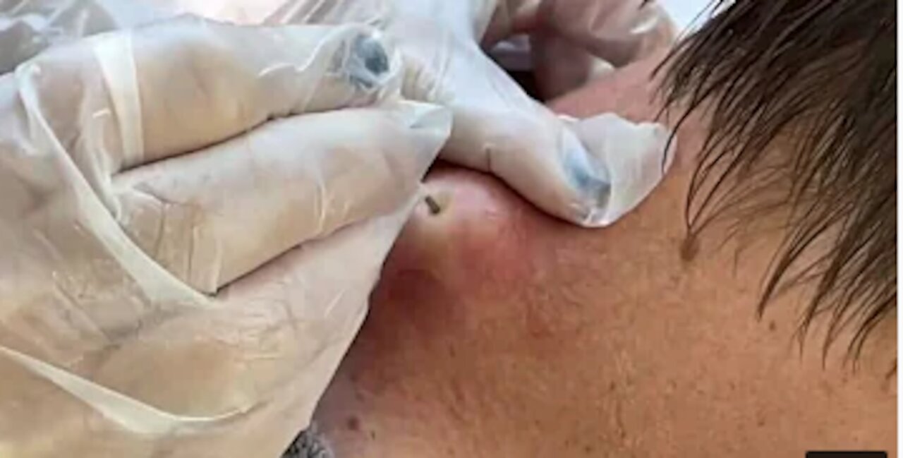 Satisfying Explosive Pimple Popping Videos