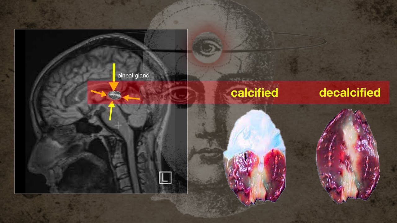 I Finally Decalcified My Pineal Gland! Here's How