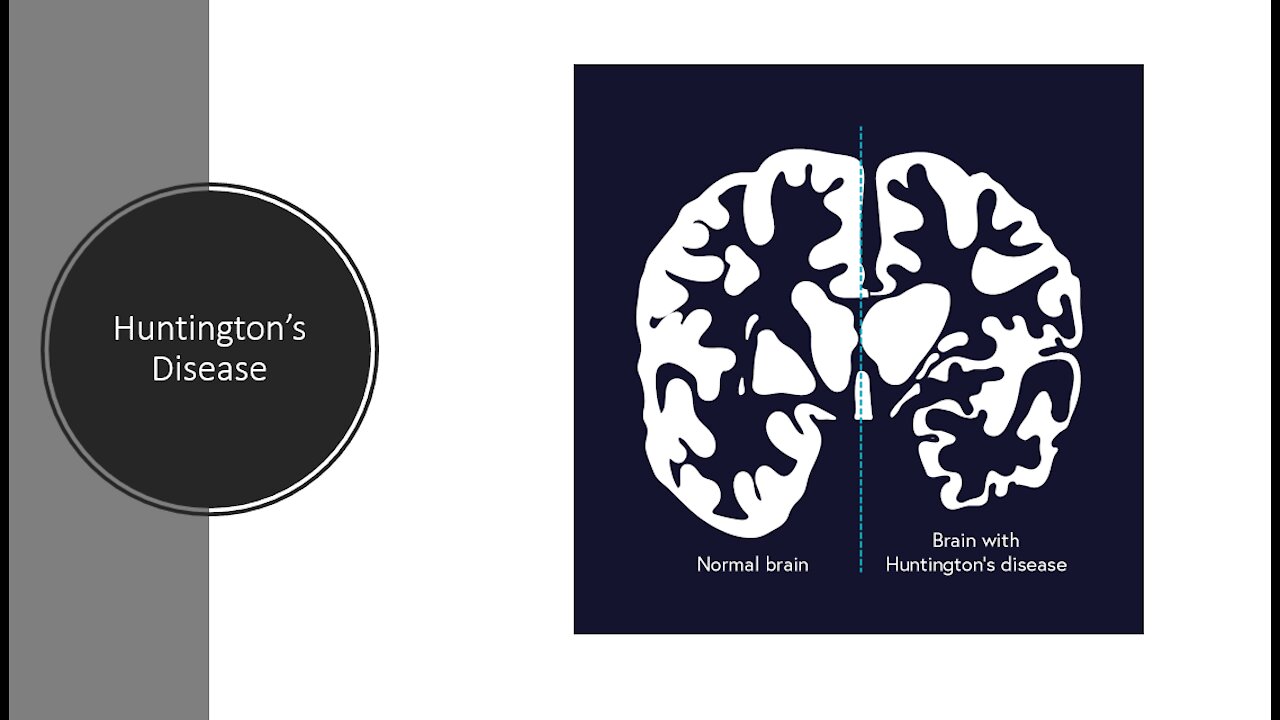 Huntingtons Disease - Natural/Alternative Treatment Options