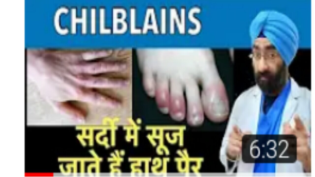 Chilblains