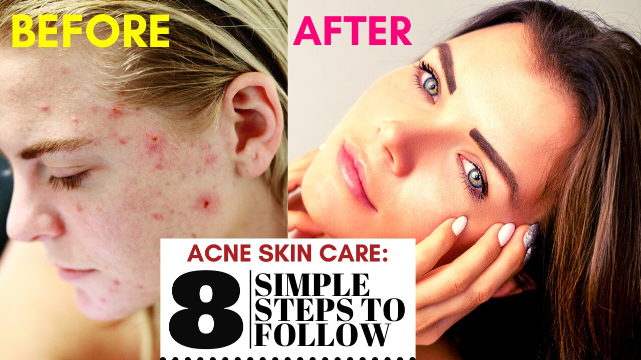 ACNE SKIN CARE: 8 Simple Tips To Follow