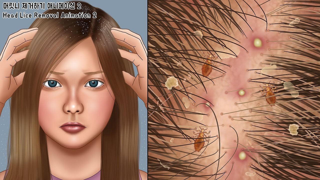 ASMR 보기만 해도 근질근질~ 머릿니 시원하게 제거하기 2ㅣ지루성 두피 치료ㅣGet rid of tons of head lice2