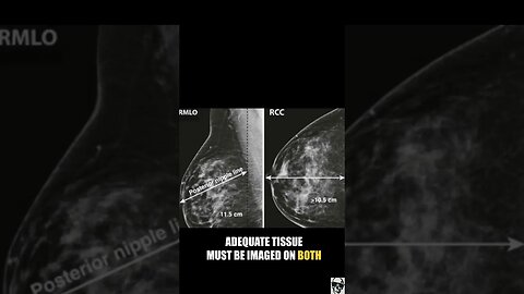 Screening Mammography