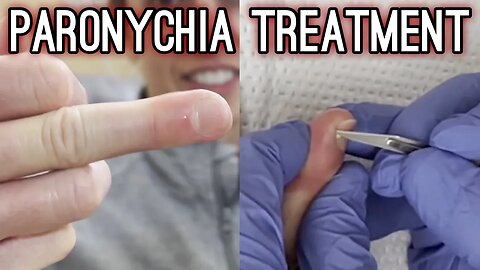 SATISFYING Drainage of Infected Cuticle | Paronychia Treatment - #TheBubbaArmy