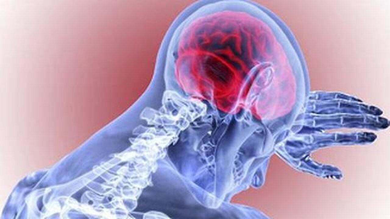 STROKE AND BRAIN BLEED TRIGGERED WITH 5G TECHNOLOGY AND SMART DUST THAT IS IN YOUR BODY