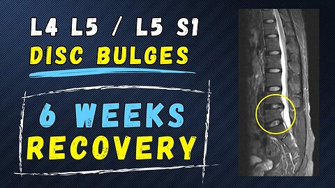How to recover from lumbar l4 l5 / l5 S1 disc bulges at home