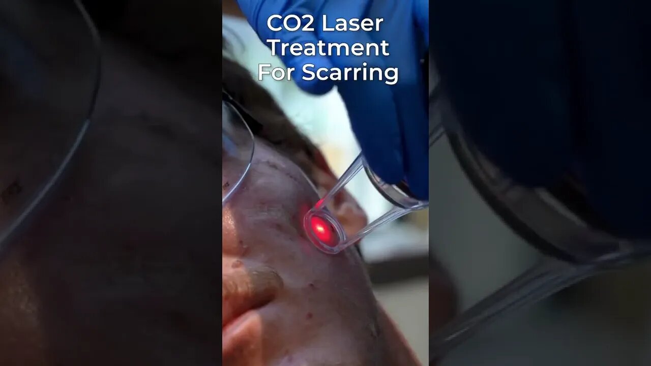 Healing Scars With A Laser! 😯🥽