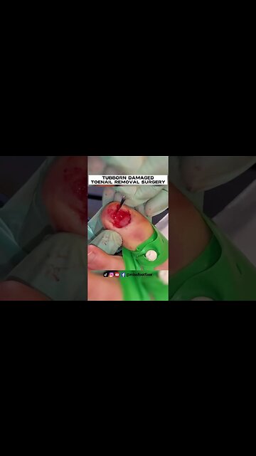 STUBBORN DAMAGED TOENAIL REMOVAL SURGERY 2023 BY FAMOUS PODIATRIST MISS FOOT FIXER