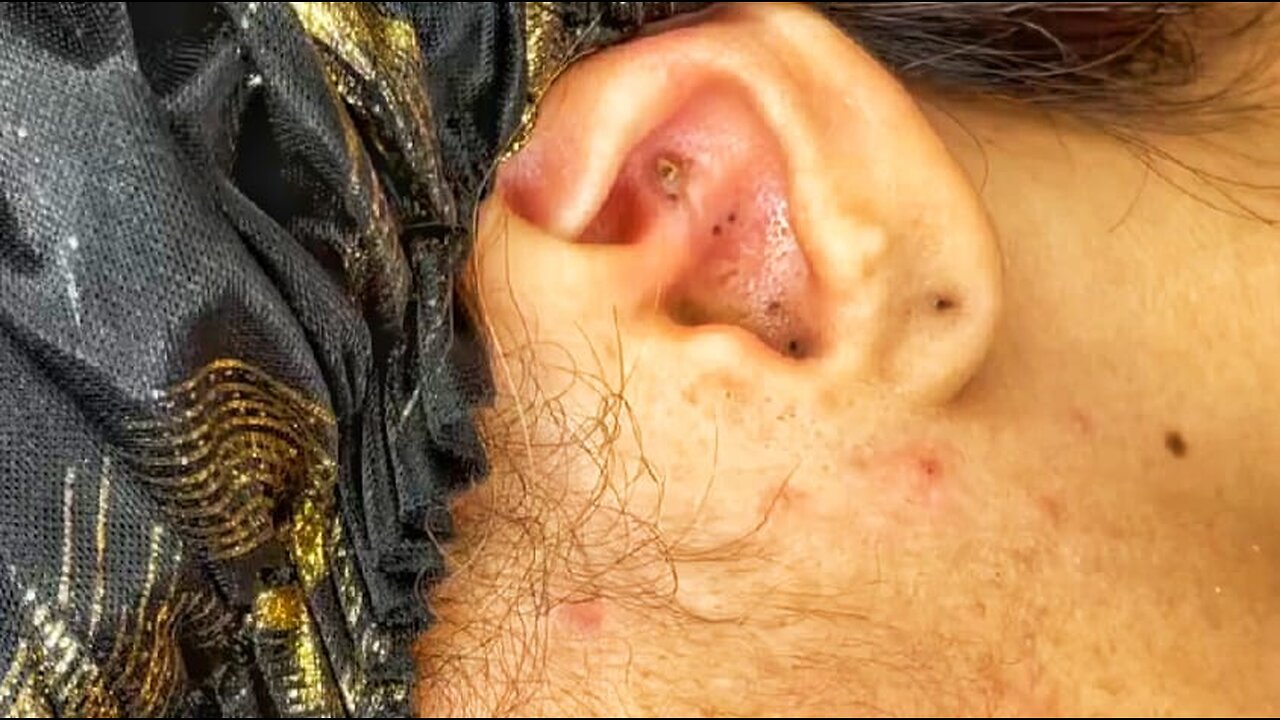 Blackheads in Ear