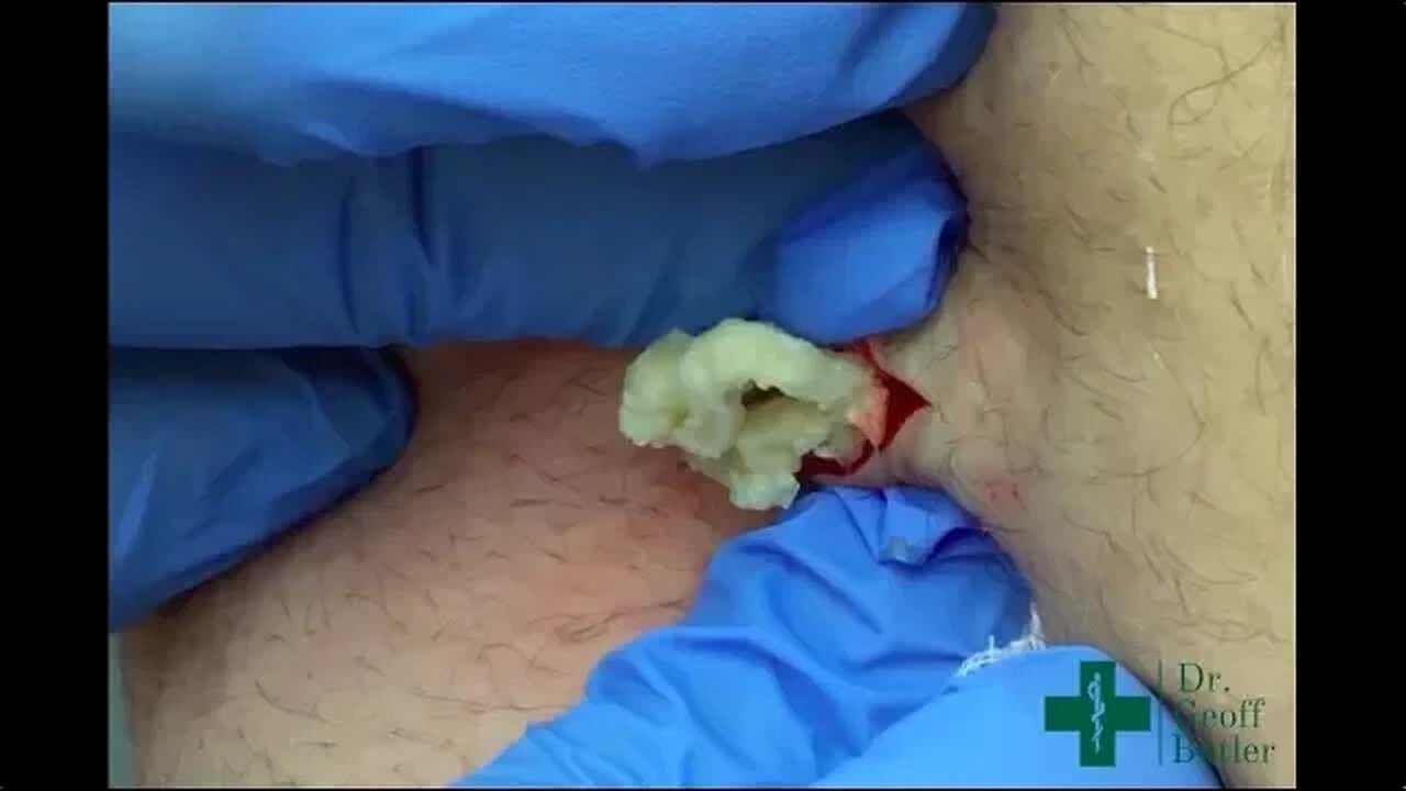 Removal of an Epidermal Cyst on the Lower Back