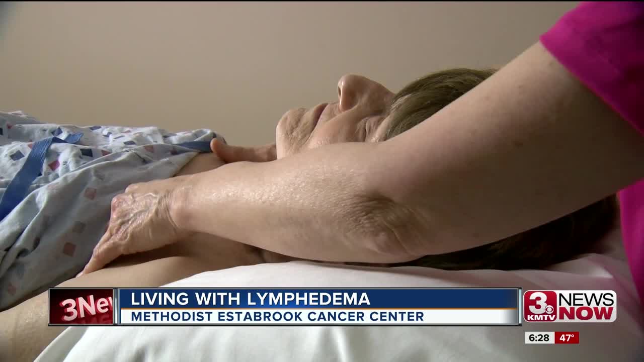 Living with Lymphedema