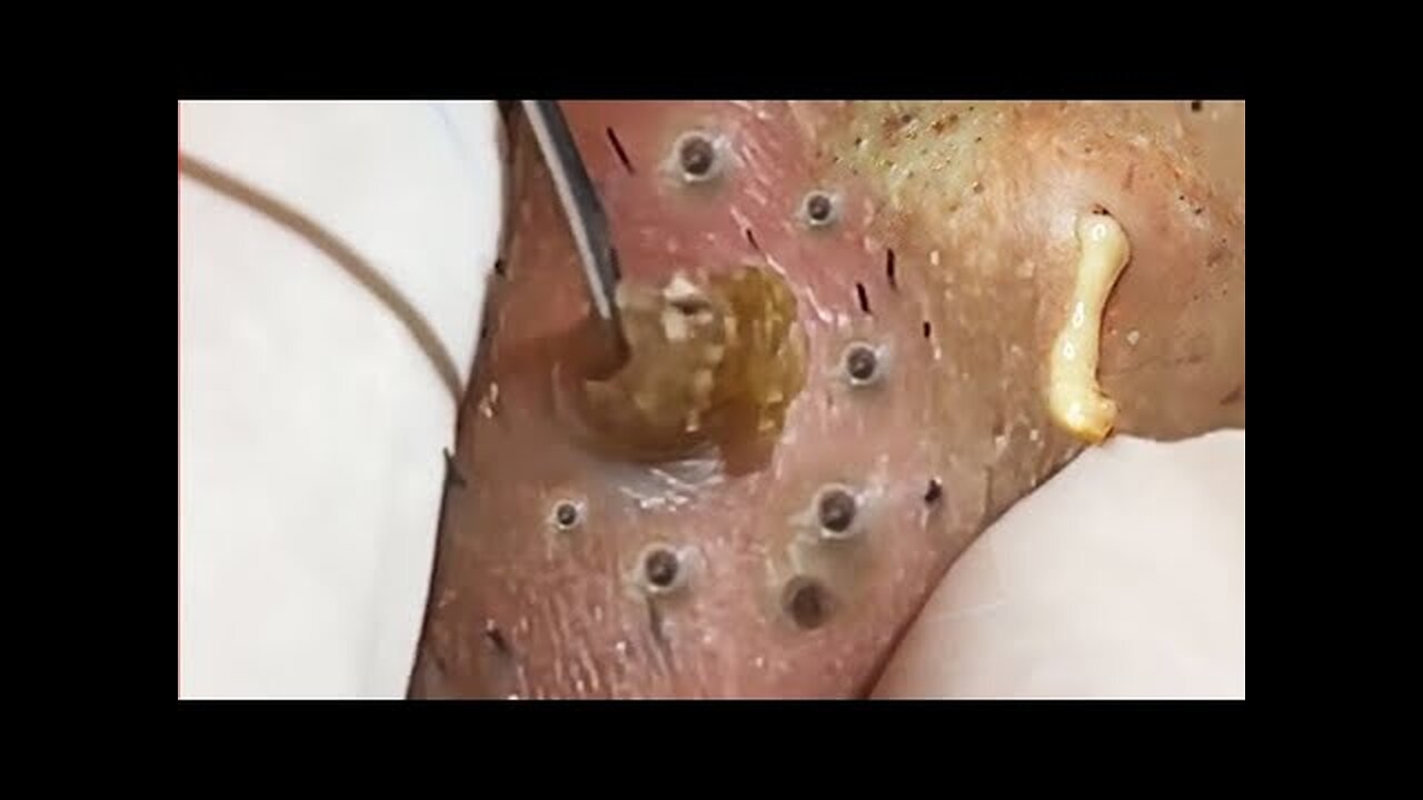 Satisfying blackhead removal, relaxing Pimple Popping 1112