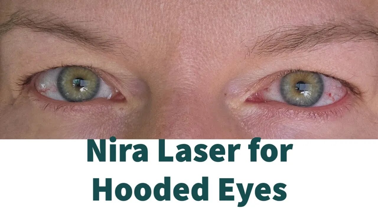 Nira Laser Unboxing and Initial Impressions for Hooded Eyes