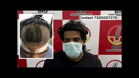 1.5 years hair transplant results (before after)